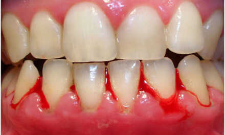 Bleeding Gums: Causes and Treatment