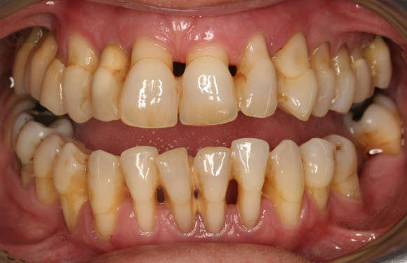 Periodontitis Causes, Types and Symptoms Treatment and Periodontitis Causes, Types and Symptoms Treatment and