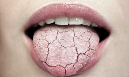 Dry Mouth or Xerostomia: Causes, Symptoms & Treatment/Prevention