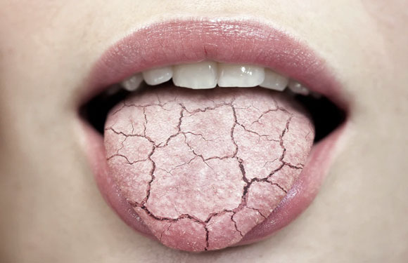 Dry Mouth or Xerostomia: Causes, Symptoms & Treatment/Prevention