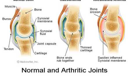 Arthrite : Causes et Symptômes, Formes, Traitement et Prévention