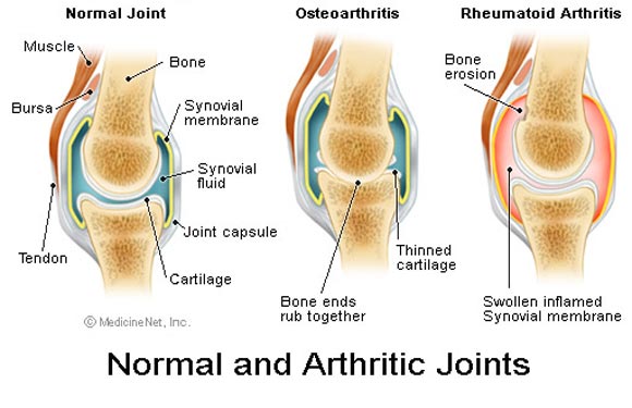 Arthrose : Causes et Symptômes, Types, Traitement et Prévention