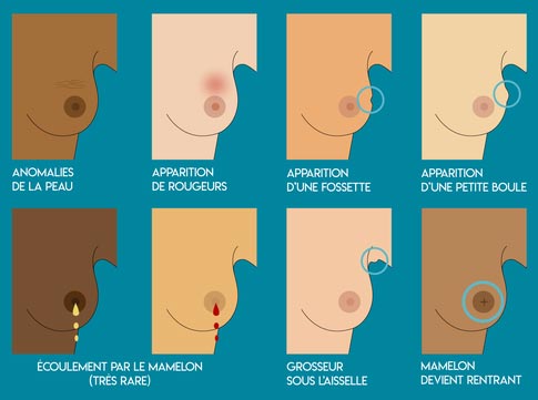 Symptômes du Cancer du Sein