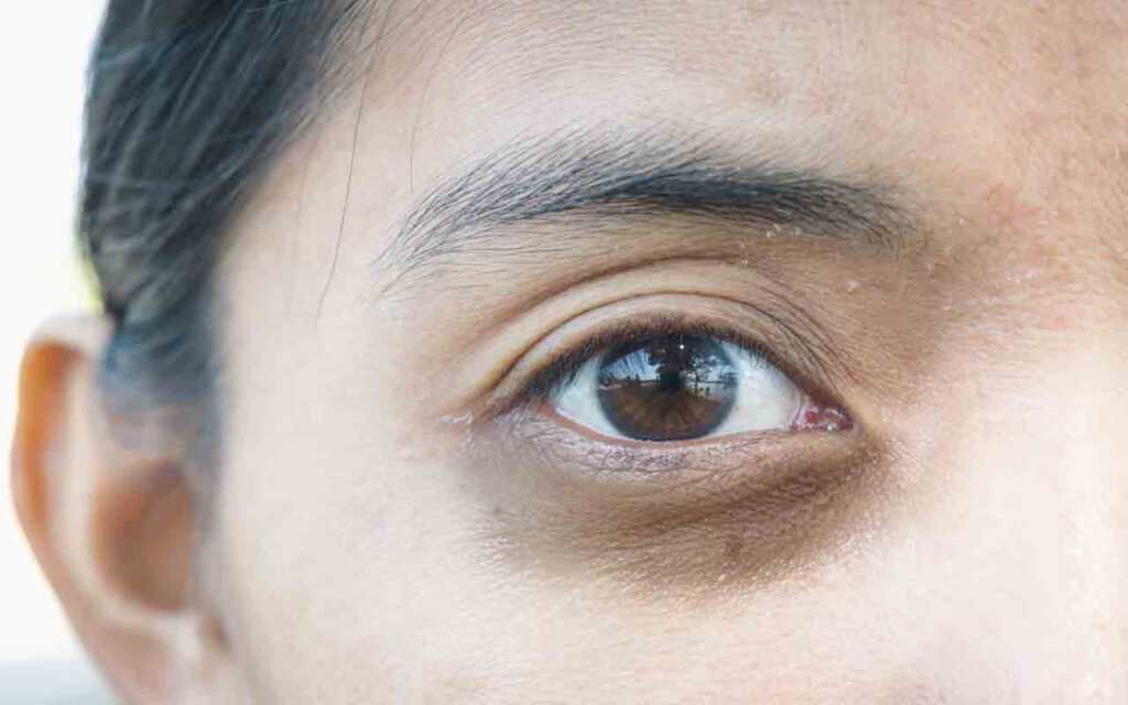 Cernes sous les yeux