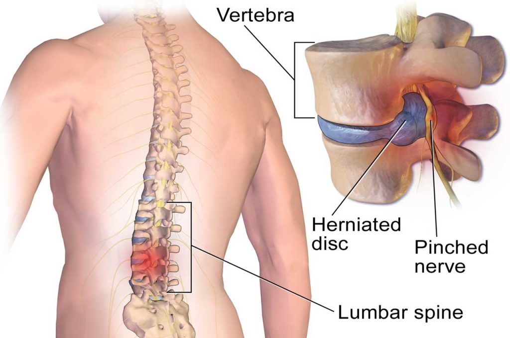 Hernie Discale - Vue Latérale