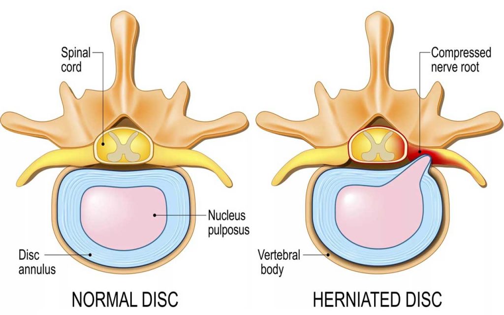 Hernie Discale - Vue Supérieure avec Coupe Transversale