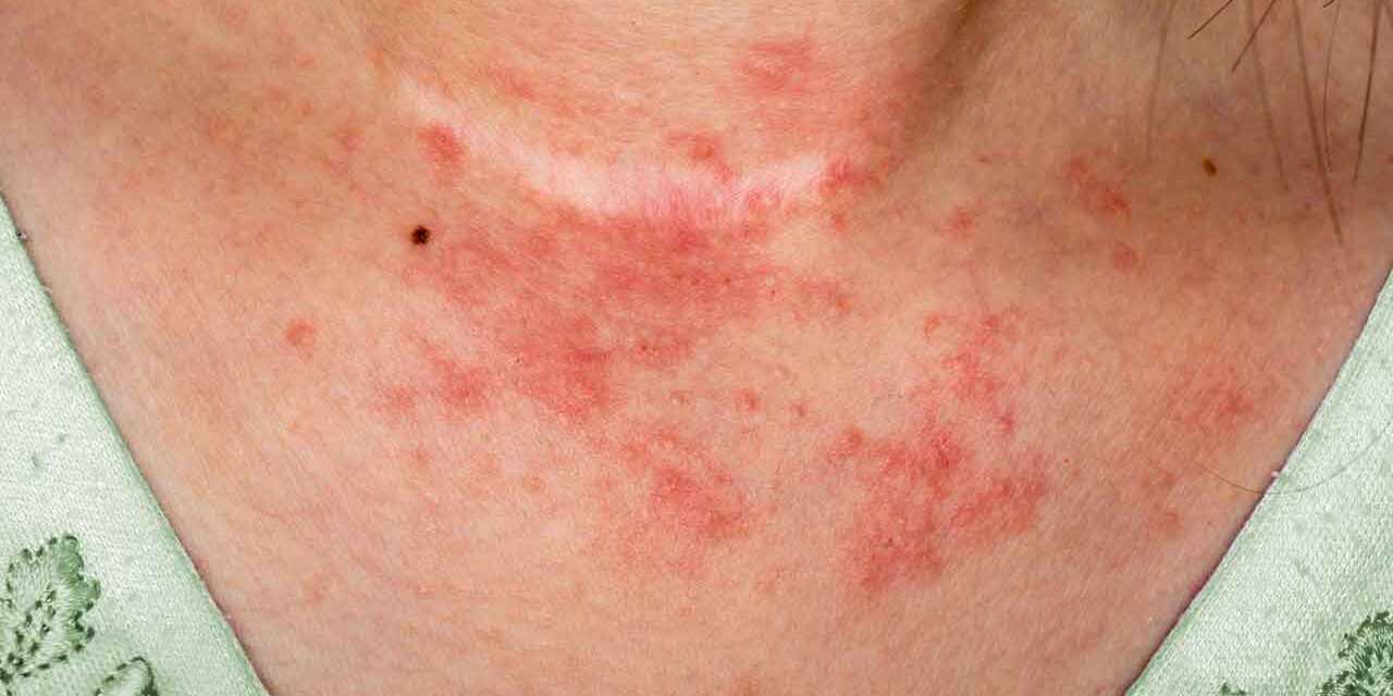 Eczéma : Types, Symptômes, Evolution et Complications – Traitement et Prévention