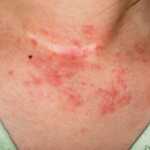 Top 12 des Remèdes de Grand-Mère pour Traiter Naturellement l’Eczéma