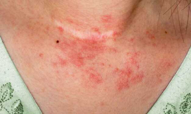 Top 12 des Remèdes de Grand-Mère pour Traiter Naturellement l’Eczéma