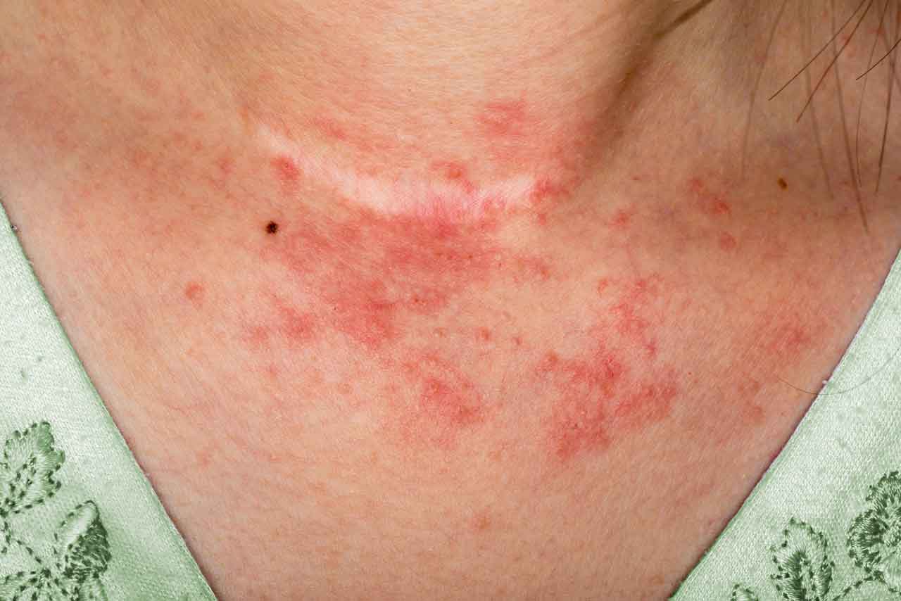 Eczéma Types, Symptômes, Evolution et Complications Traitement et