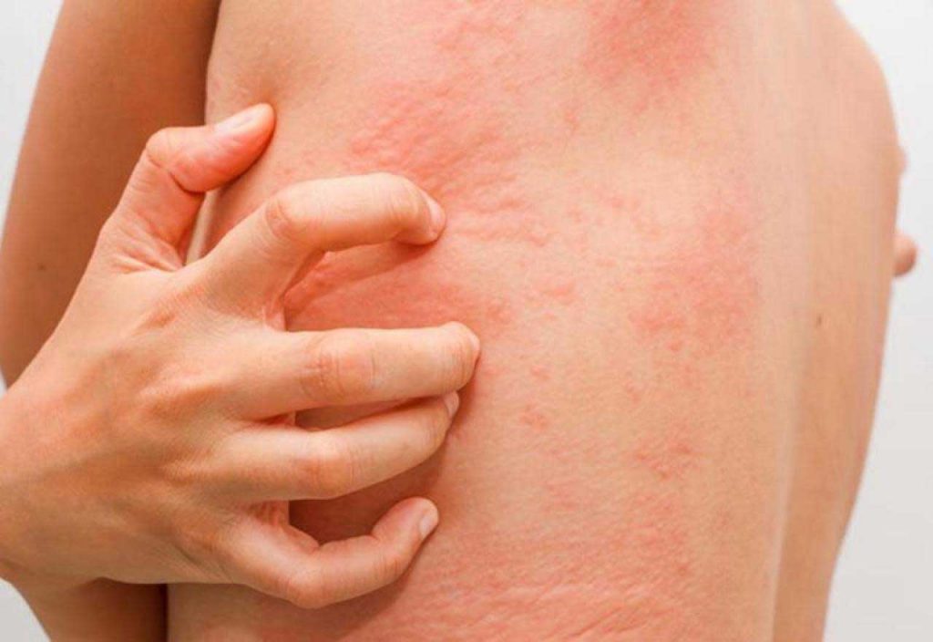 L'eczéma se manifeste avec la démangeaison (prurit)