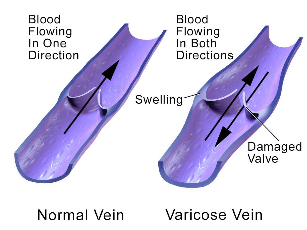 Anatomie d'une varice et valve endommagée