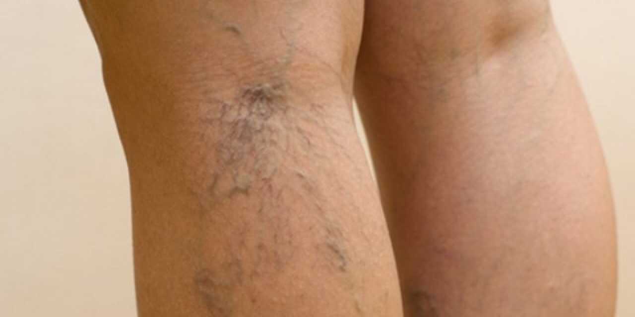 Varices des Jambes et Pieds : Causes, Symptômes et Complications – Traitement et Prévention