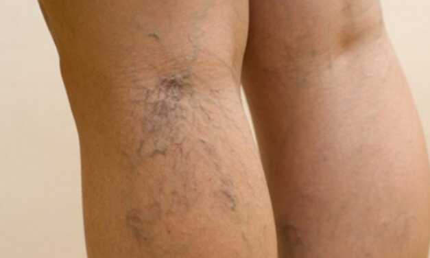 Guide Complet des Jambes Lourdes : Causes, Traitement et Prévention