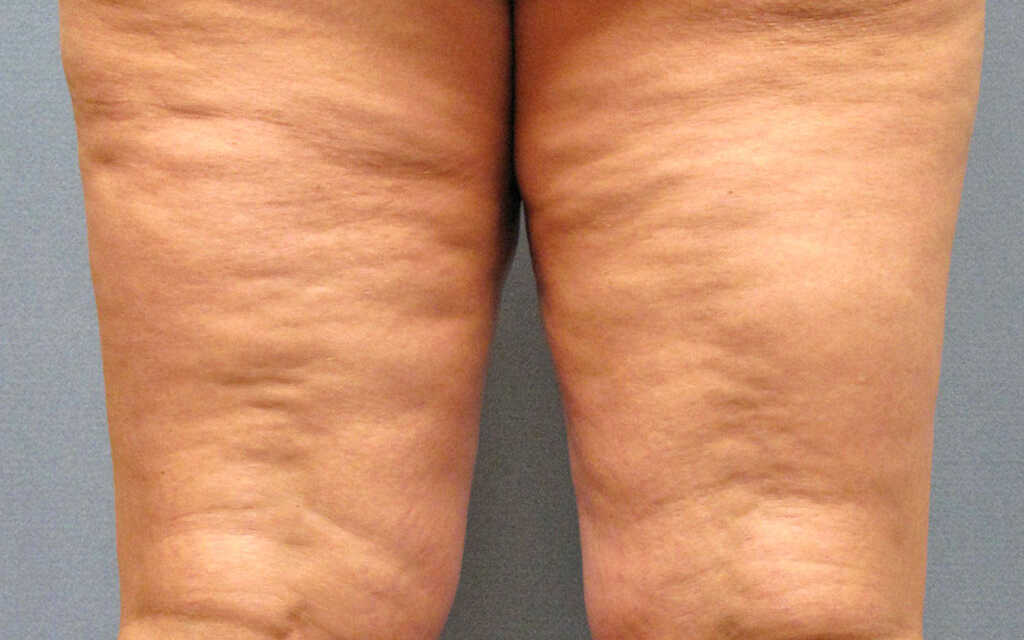 13 Conseils et Astuces pour Éliminer la Cellulite Naturellement