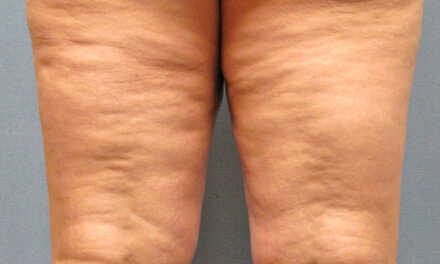 13 Conseils et Astuces pour Éliminer la Cellulite Naturellement