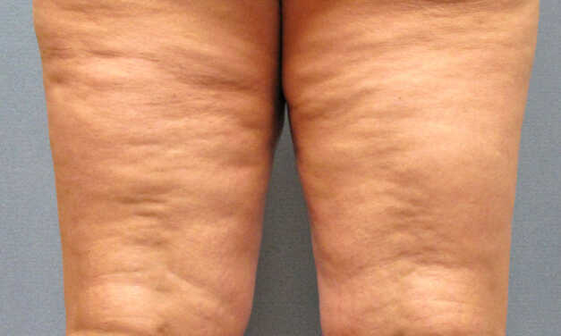 13 Conseils et Astuces pour Éliminer la Cellulite Naturellement