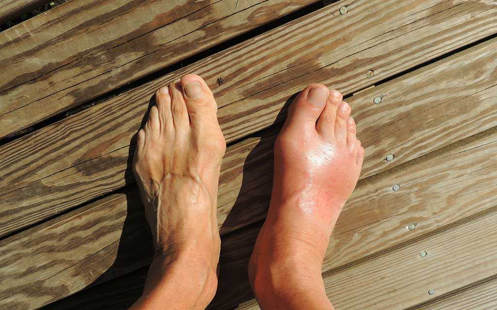 Gout: Causes, Symptoms, Treatment and Prevention