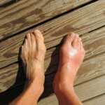 Gout: Causes, Symptoms, Treatment and Prevention
