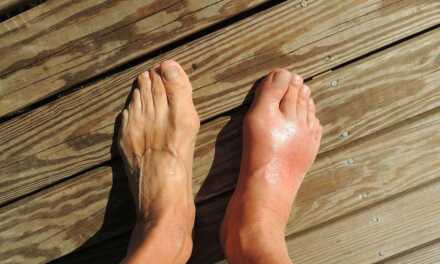 Gout: Causes, Symptoms, Treatment and Prevention