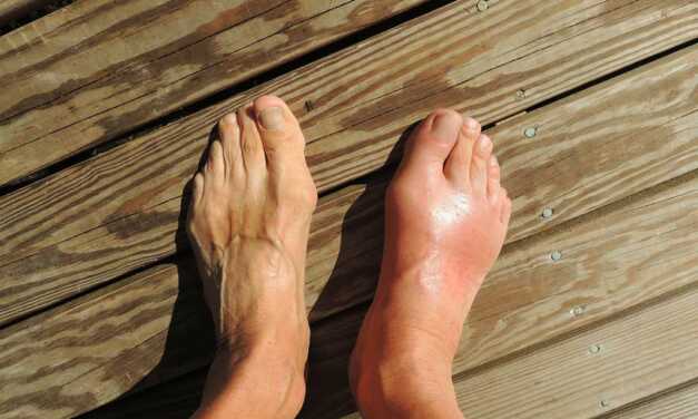 Tout sur la Goutte : Causes et Symptômes, Complications, Traitement et Prévention