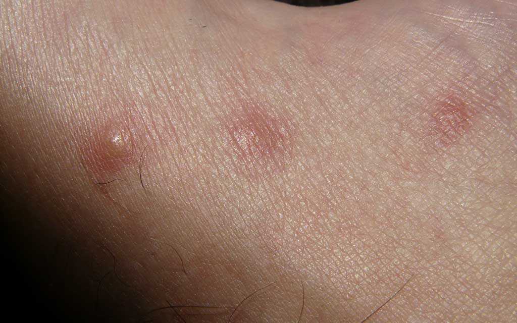 Allergie Cutanée : Causes et Symptômes, Diagnostic, Traitement et Prévention