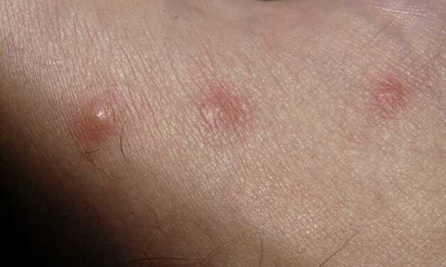 Allergie Cutanée : Causes et Symptômes, Diagnostic, Traitement et Prévention