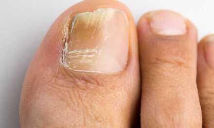 10 Traitements Naturels et Remèdes de Grand-Mère pour Traiter la Mycose des Ongles