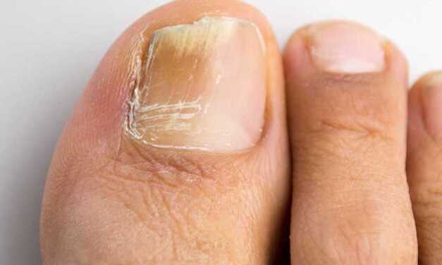 10 Traitements Naturels et Remèdes de Grand-Mère pour Traiter la Mycose des Ongles