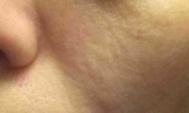 Peau Granuleuse : Causes, Traitement et Prévention