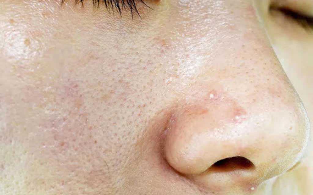Peau Grasse : Comment Prendre soin de Votre Peau Grasse