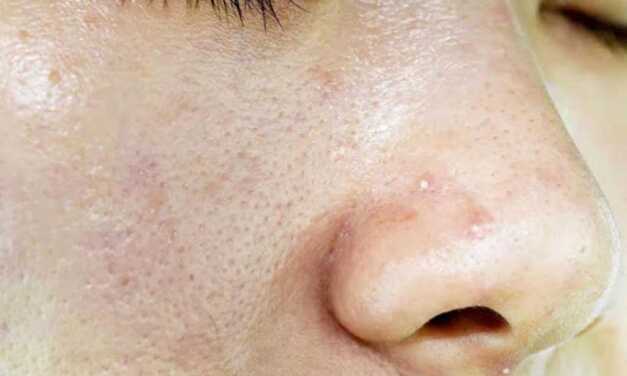 Peau Grasse : Comment Prendre soin de Votre Peau Grasse