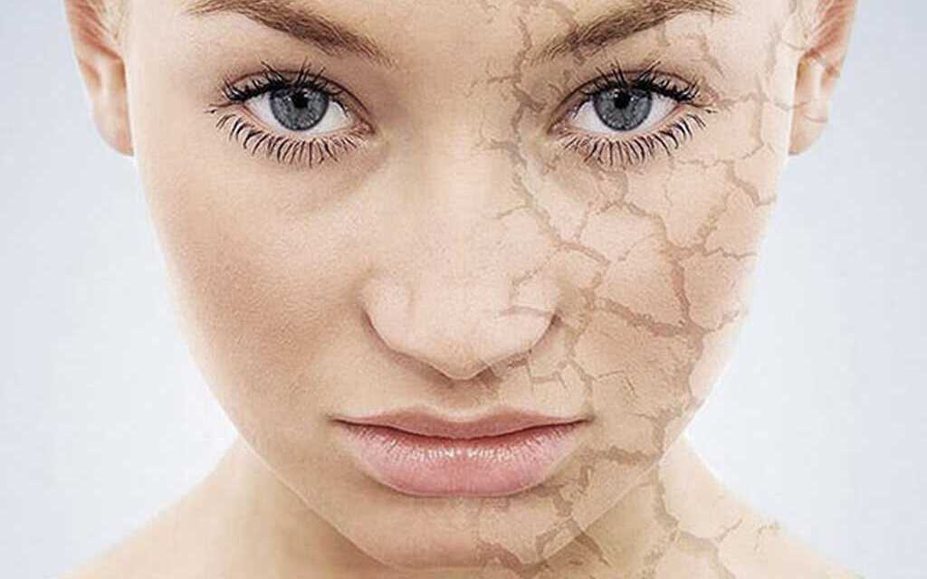 Peau Sèche : Causes, Symptômes, Prévention et Traitement
