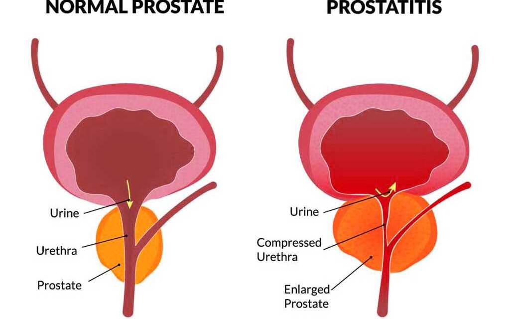 Prostatite : Causes et Symptômes, Diagnostic, Traitement et Prévention