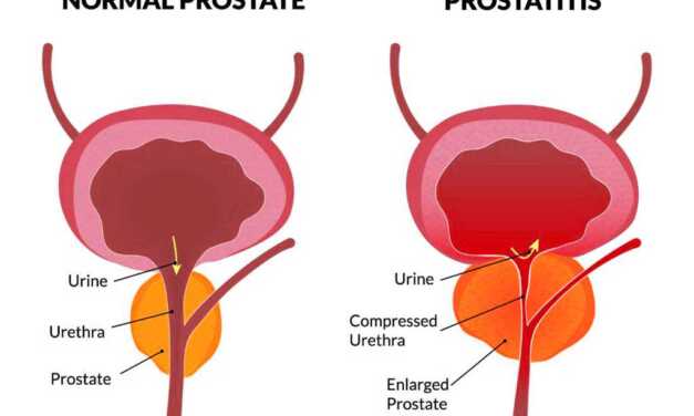 Prostatite : Causes et Symptômes, Diagnostic, Traitement et Prévention