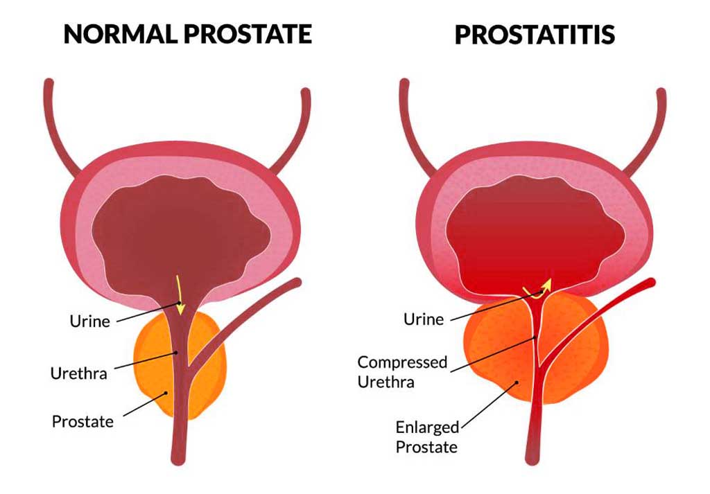 Prostatite Causes et Symptômes, Diagnostic, Traitement et Prévention Maxi Potion