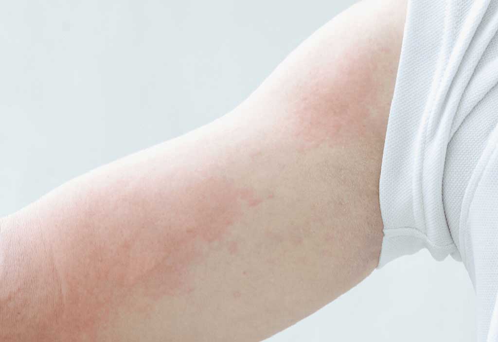 Urticaire Types, Causes et Symptômes, Prévention et Traitement Maxi