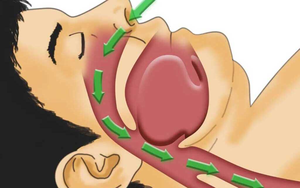 Guide de l’Apnée du Sommeil Ou Syndrome d’Apnée