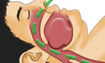 Guide de l&rsquo;Apnée du Sommeil Ou Syndrome d’Apnée
