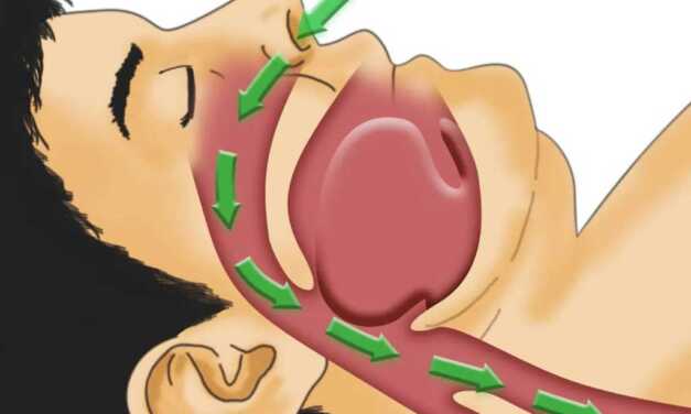Guide de l&rsquo;Apnée du Sommeil Ou Syndrome d’Apnée