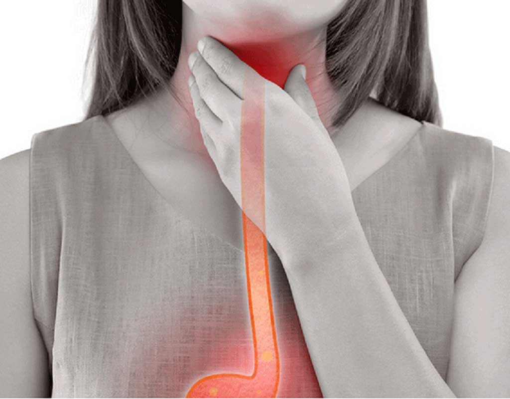 Guide Définitif du Reflux Gastrique Maxi Potion