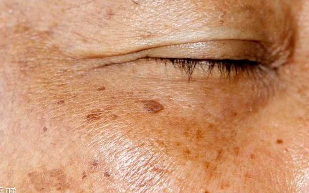 10 Conseils pour Lutter Contre les Taches Brunes de Vieillesse