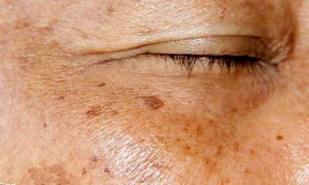 10 Conseils pour Lutter Contre les Taches Brunes de Vieillesse